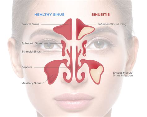 Maxillary Sinus Infection