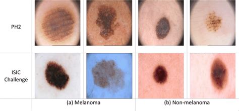 Example Of Melanoma And Non Melanoma Skin Cancer From Ph2 Database And