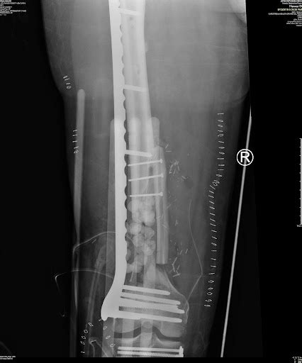 Broken Leg With Pins Xray Orthopedic Institute Of Pennsylvania