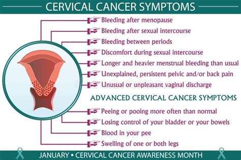 Sintomas Do Câncer Cervical Ilustração Infográfica Do Vetor Ilustração do Vetor Ilustração de