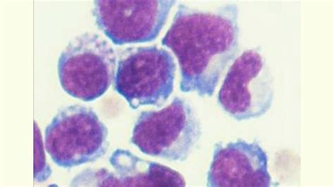 Engineered Bone Marrow Cells Slow Growth Of Prostate And Pancreatic