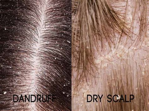 Is It Dandruff Or A Dry Scalp Theres Actually A Big Difference Dry My