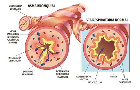 Diferencia Entre Bronquitis Y Asma El Botiqu N Natural