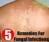 Home Remedies Fungal Rash