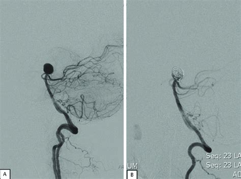 Dsa Lateral Projection A Showing A Wide Necked Basilar Top Aneurysm