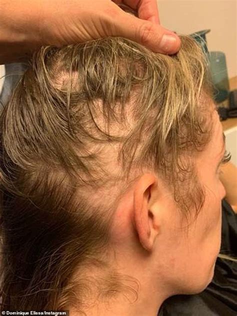 Mum Who Lost Her Hair After Giving Birth Reveals How She Transformed