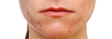 How To Get Rid Of Acne Scars On Lips