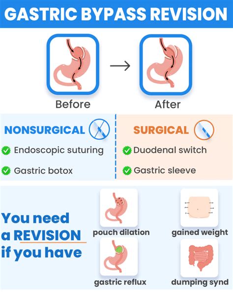 Gastric Bypass Revision Why And When To Get One