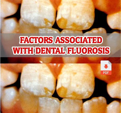 Pdf Factors Associated With Dental Fluorosis