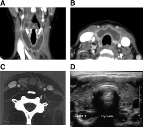 Ct Scan Revealed Hypodensity In The Central Area Of Thyroid Contrasting