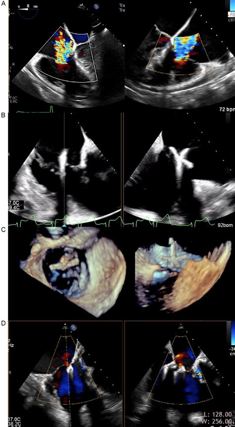 Tricuspid Valve Percutaneous Repair Using The Triclip System A