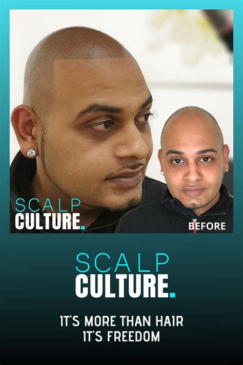 Scalp Micropigmentation Male Pattern Baldness Hair Tattoos Alopecia