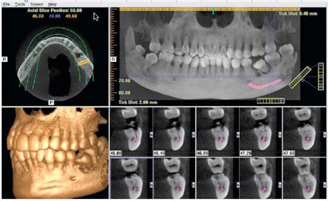 About Your Teeth Cone Bean Computerised Tomography Cbct About Your
