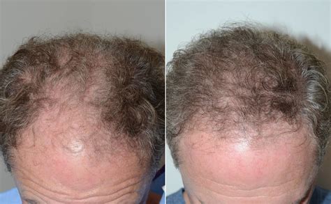 Patient Foundation For Hair Restoration