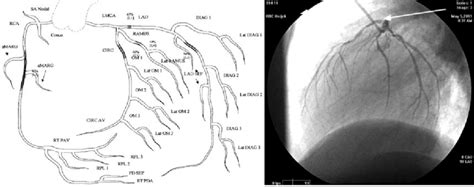 Learn more from cleveland clinic about how the two major coronary the rest of the right coronary artery and its main branch, the posterior descending artery when the coronary arteries narrow to the point that blood flow to the heart muscle is limited. A) Schematic representation of coronarography describing ...