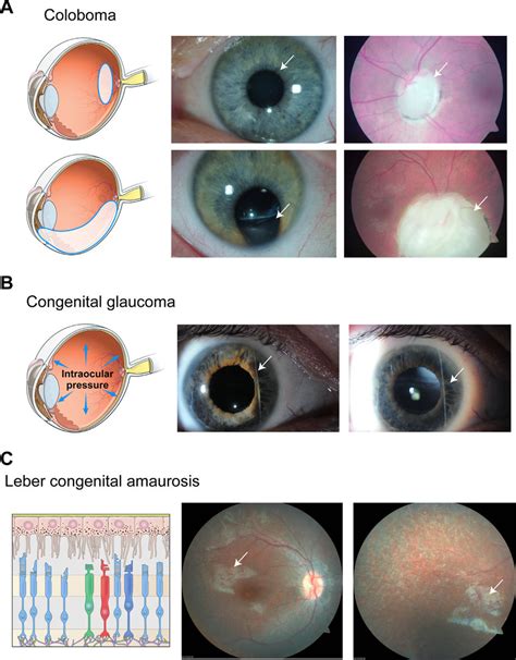 Etiology And Phenotypes Of Pediatric Eye Diseases A Coloboma Optic