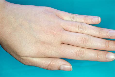 Dry Patches On Hands In Winter