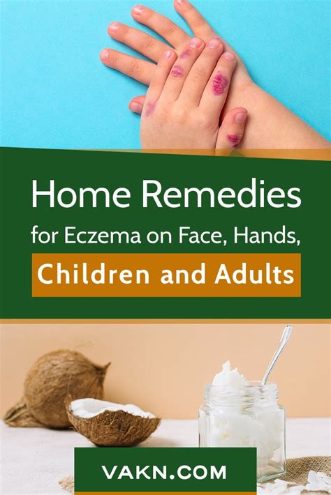 Best Home Remedies For Eczema Itch Dryness On Face Hands And Legs In