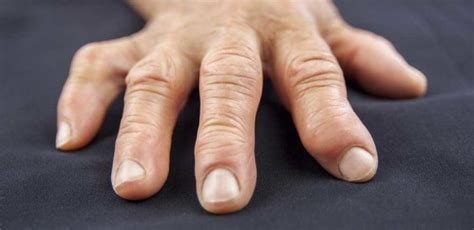 5 Causes Of Swollen Fingers All Answers