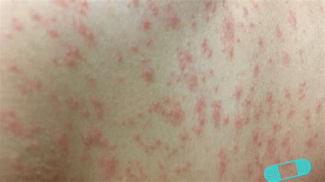 212 Images Of Viral Rashes Myweb