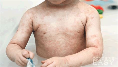 How To Treat Childrens Skin Rashes