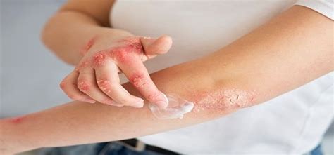 Skin Rashes Causes Symptoms Red Flags And Treatment