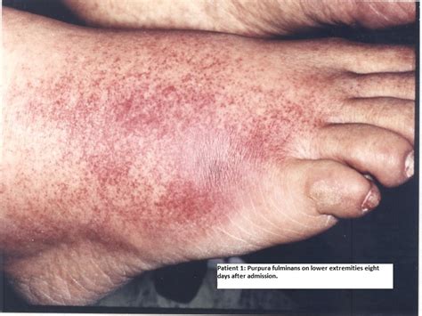 Pseudomonas Aeruginosa Burn Infection