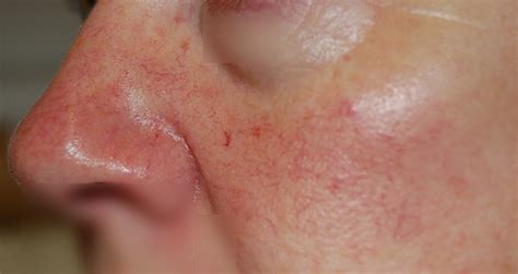 Red Spots On Skin Blood Vessels