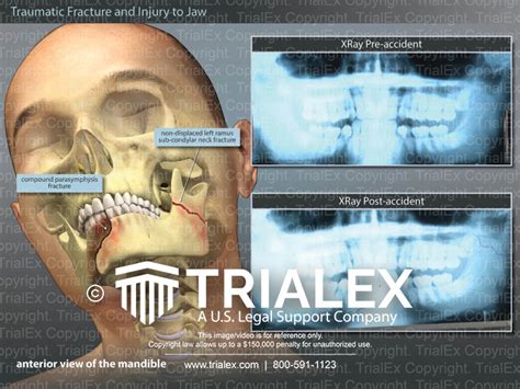 Traumatic Fracture And Injury To The Jaw Trial Exhibits Inc