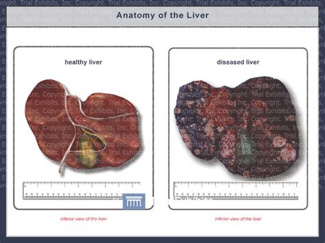The Anatomy Of A Healthy And Diseased Liver Trial Exhibits Inc