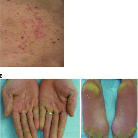 Skin Rashes Include A Erythema Maculopapular Dermatitis Or