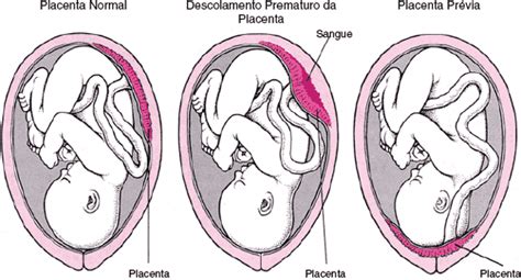 Anjinho Lucas Descolamento Prematuro De De Placenta