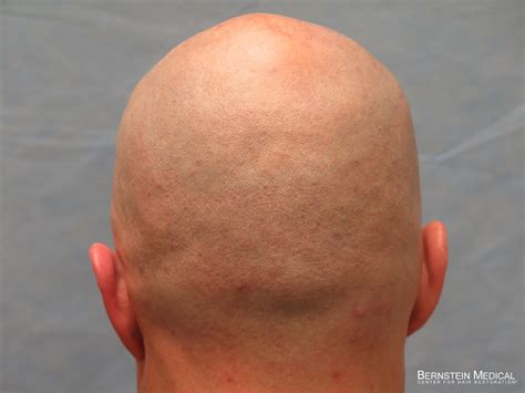 Top 140 Hair Transplant Scar Shaved Head Polarrunningexpeditions