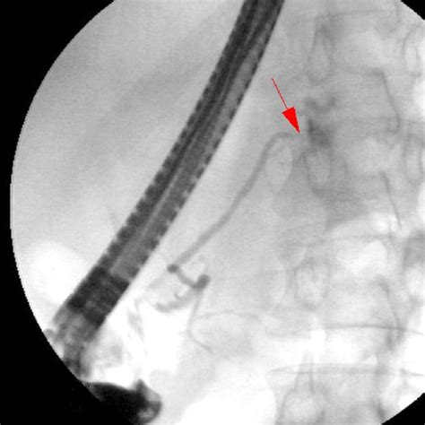 Endoscopic Retrograde Cholangiopancreatography Showing The Location Of