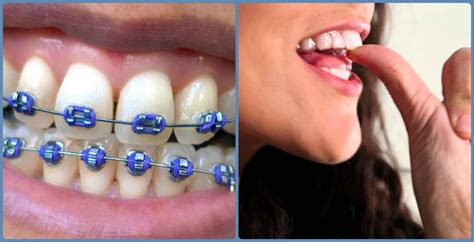 Edmond Dentist Explains Clear Braces Vs Metal Braces Gray Dental