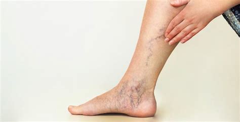 How To Get Rid Of Unsightly Veins In Your Feet Francine Rhinehart Dpm