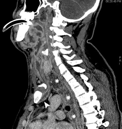 Ards Secondary To Descending Necrotizing Mediastinitis Treated By Long