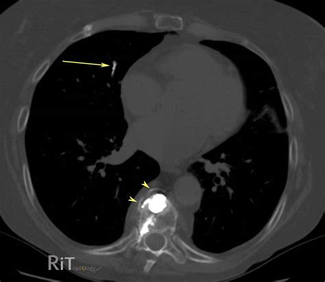 Rit Radiology Pulmonary Embolism Caused By Acrylic Cement