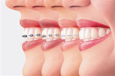 Most of the time, a good outfit, a clean hairdo, and for instance, if you often bite your cheeks, you might need to have your teeth realigned. How To Know If You Will Need Braces