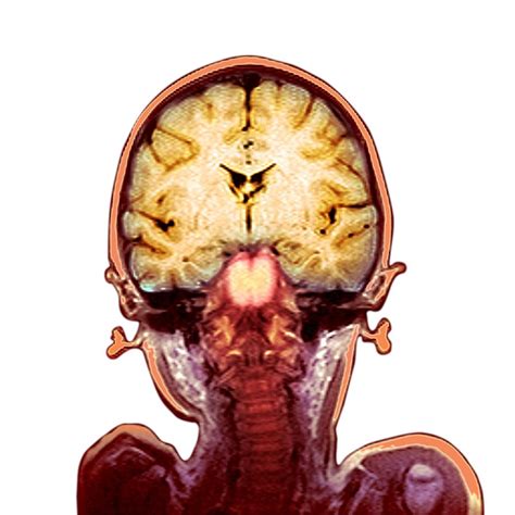 Childs Brain Mri Scan Photograph By Du Cane Medical Imaging Ltd