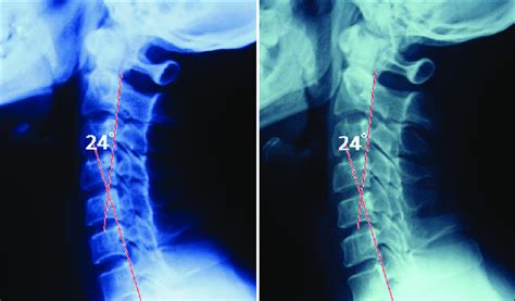 Everything You Need To Know About Cervical Lordosis Our Guide