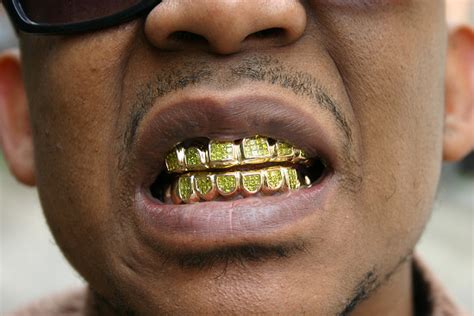 How much does permanent gold teeth cost. Sales of Gold Teeth Increase