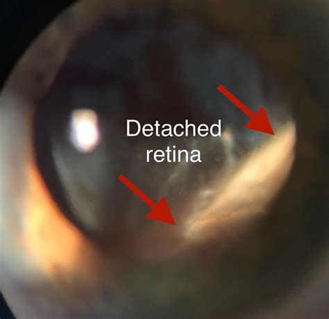Retinal Detachment Symptoms Causes Treatment Options Recovery And