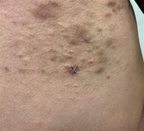 Clinical Challenge Spontaneous Rash On Trunk And Arms Mpr