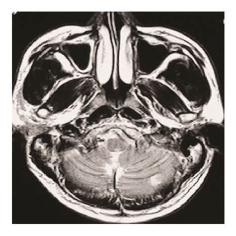 Mri A And B Showed Multiple Infarcts In The Bilateral Cerebellum