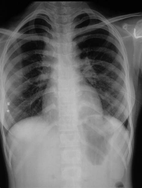 Diversities In Presentations Of Extrapulmonary Tuberculosis Bmj Case
