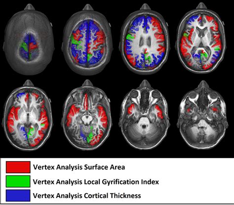 Frontiers Differences In Cortical Structure And Functional Mri