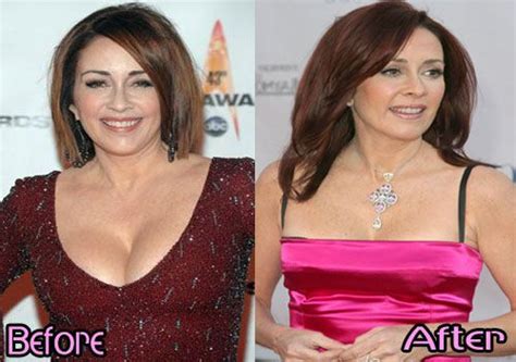 Patricia Heaton Plastic Surgery Before After Photos Celebrities