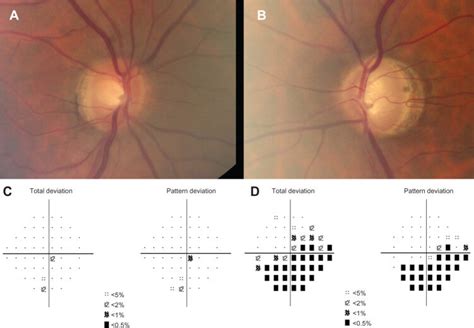 Optic Nerve Photographs Of The Right And Left Eyes Of Case 2 Optic