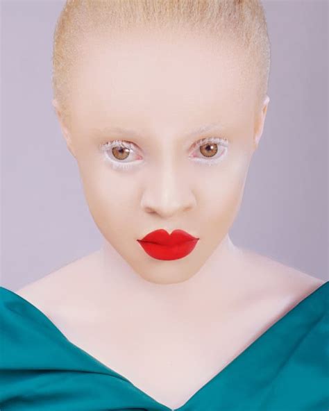 Albino Black Human